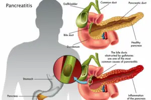 pancreatitis full details